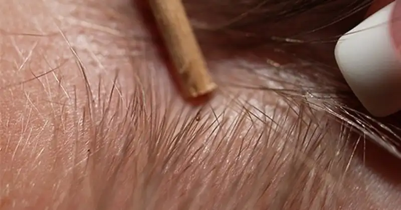 How To Treat Head Lice