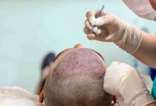 Hair Transplant infection