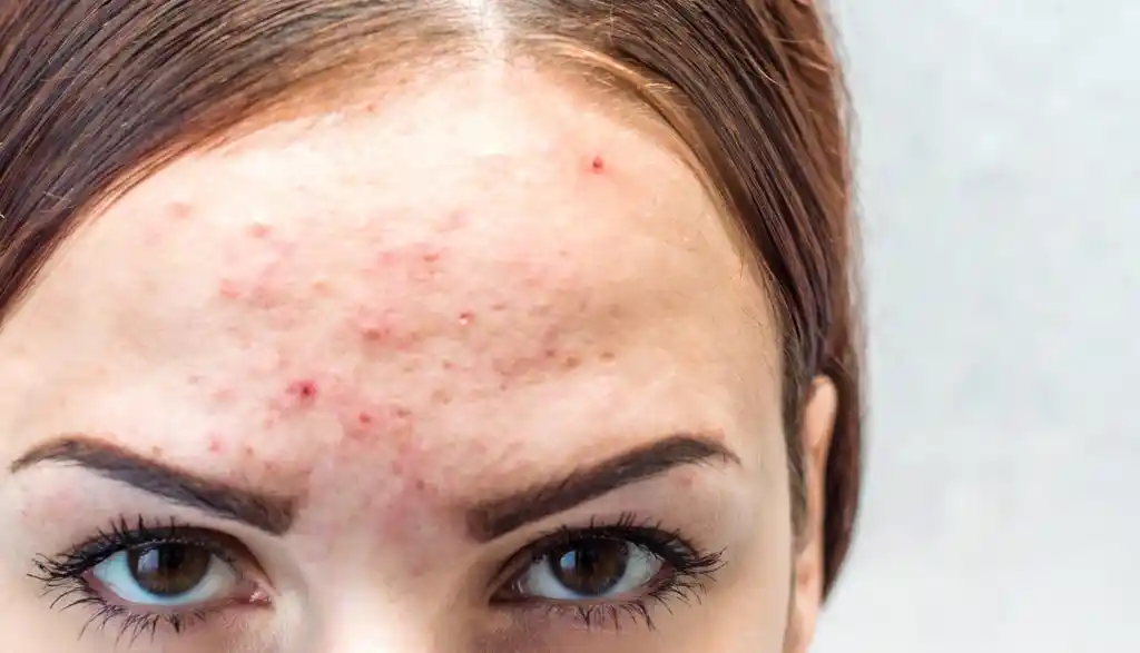 Take A Close Look At The Pimples On Your Forehead