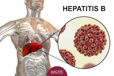 How is Hepatitis B Virus Treated