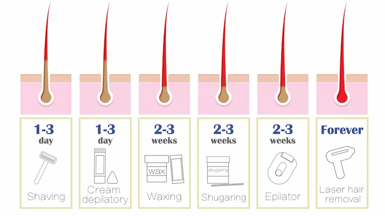 How does epilation work?
