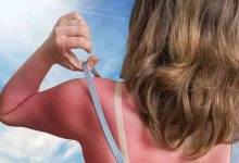 How To Heal Sunburn Fast
