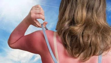 How To Heal Sunburn Fast