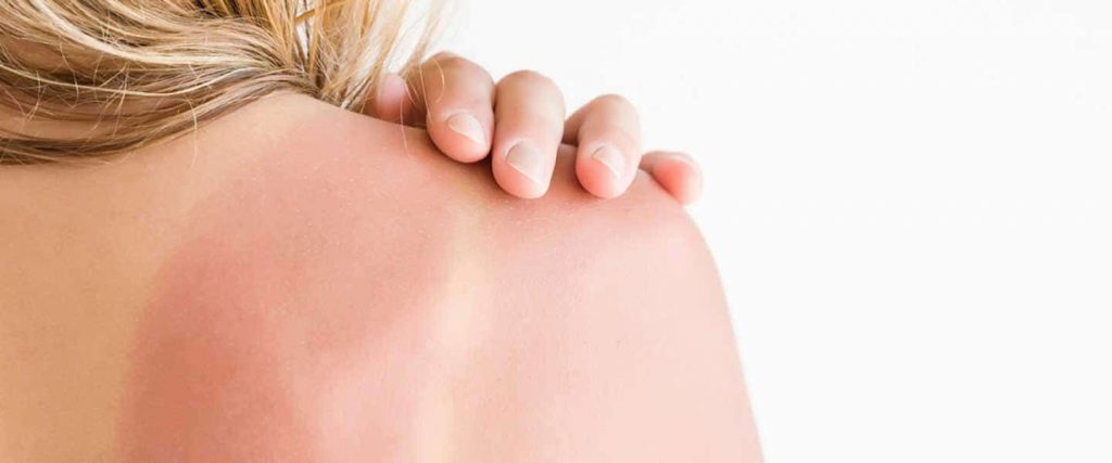 How To Heal Sunburn Fast