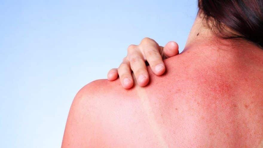 How To Heal Sunburn Fast?
