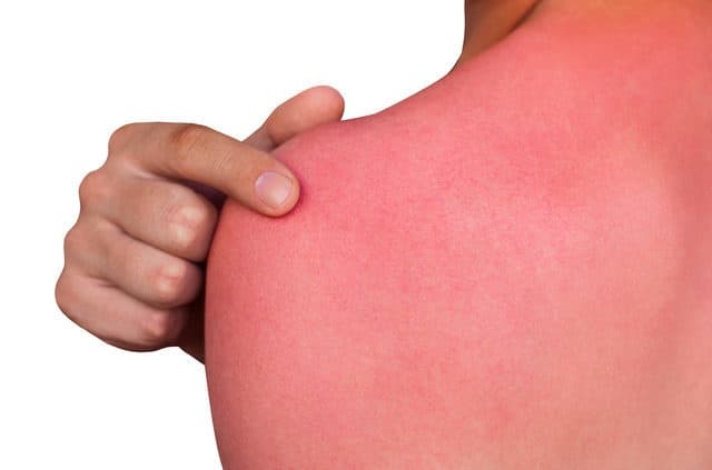 How Are Sunburns Treated?
