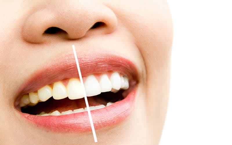 methods for whitening teeth