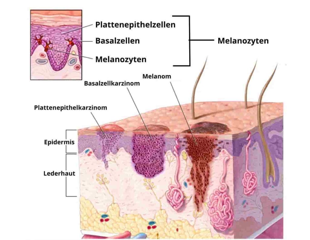 Basalzellkarzinom