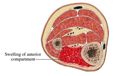 Fasciotomy