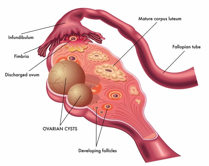 Ovarian cyst