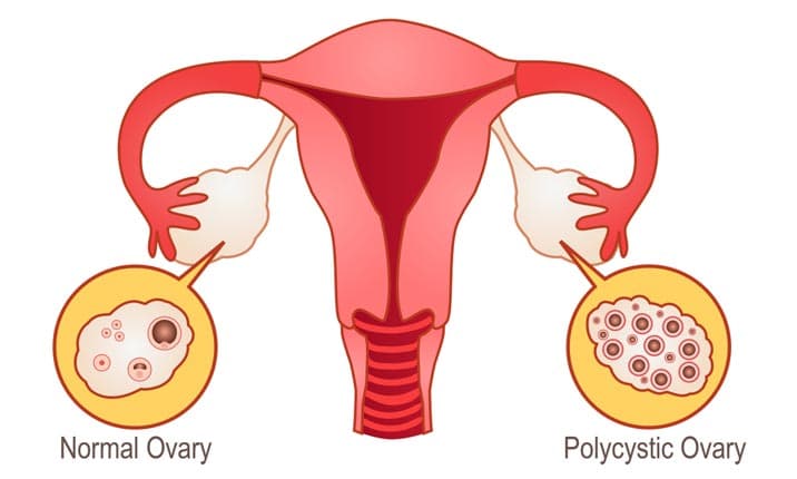 Ovarian Cysts