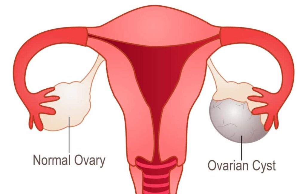 Will I Lose Weight When They Remove Ovarian Cyst