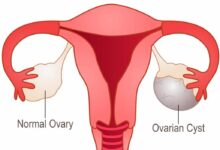 Ovarian Cyst