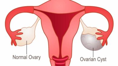 Ovarian Cyst