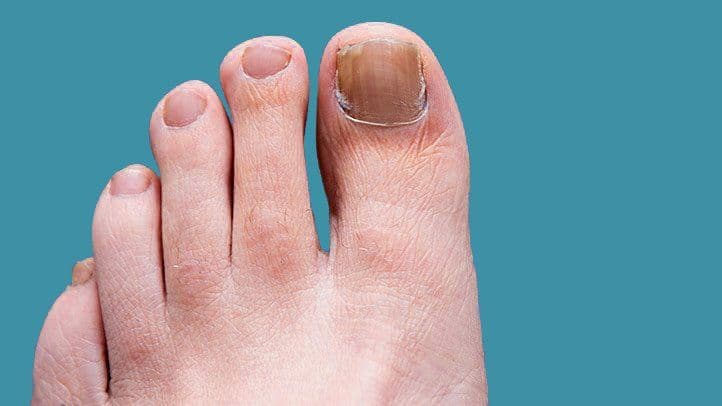 Toenail Fungus Treatment At Home