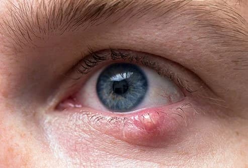 Stye Causes A Headache