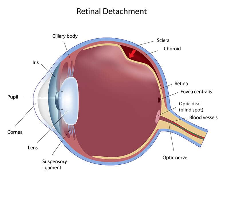 Vitreous problems