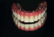 Hybrid Denture