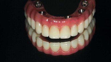 Hybrid Denture