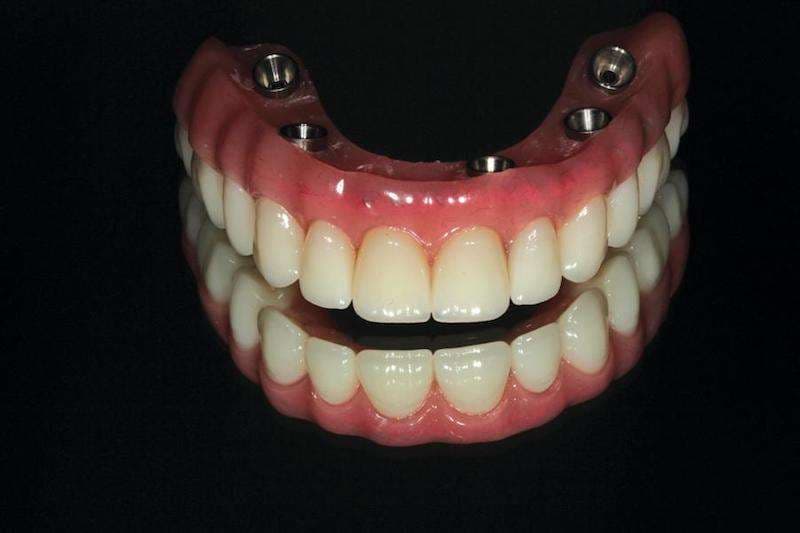 Hybrid Denture