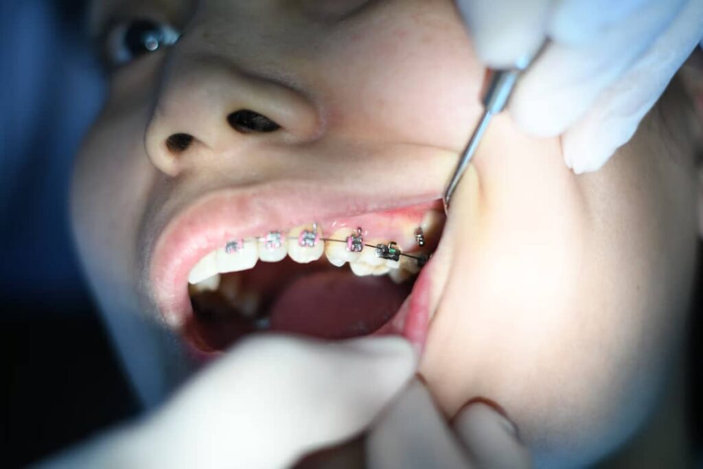 Teeth With Braces
