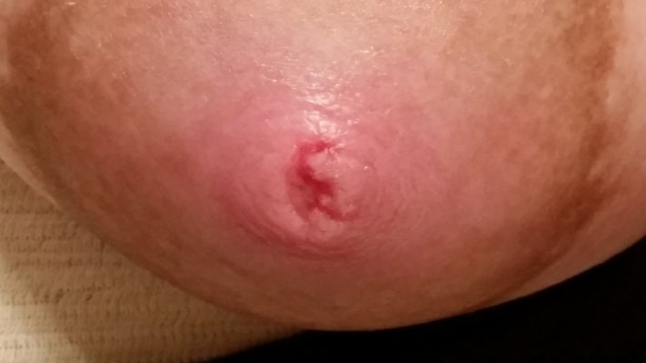 Cracked Nipple