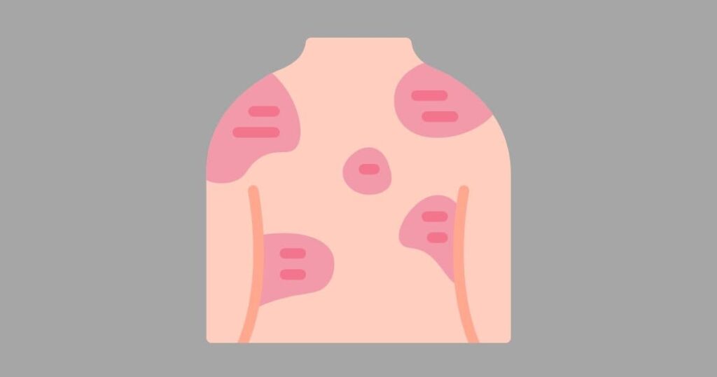 Eczema (Dermatitis): What Is It? How Is It Treated? 1 Eczema 1
