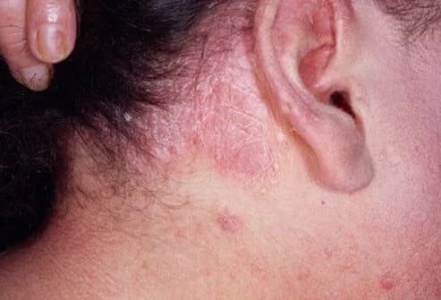 Erythrodermic Psoriasis