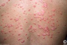 Psoriasis