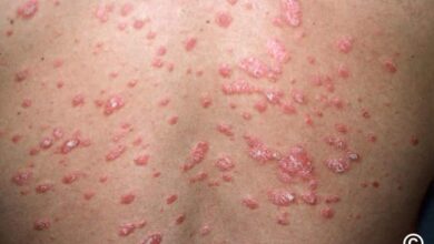 Psoriasis