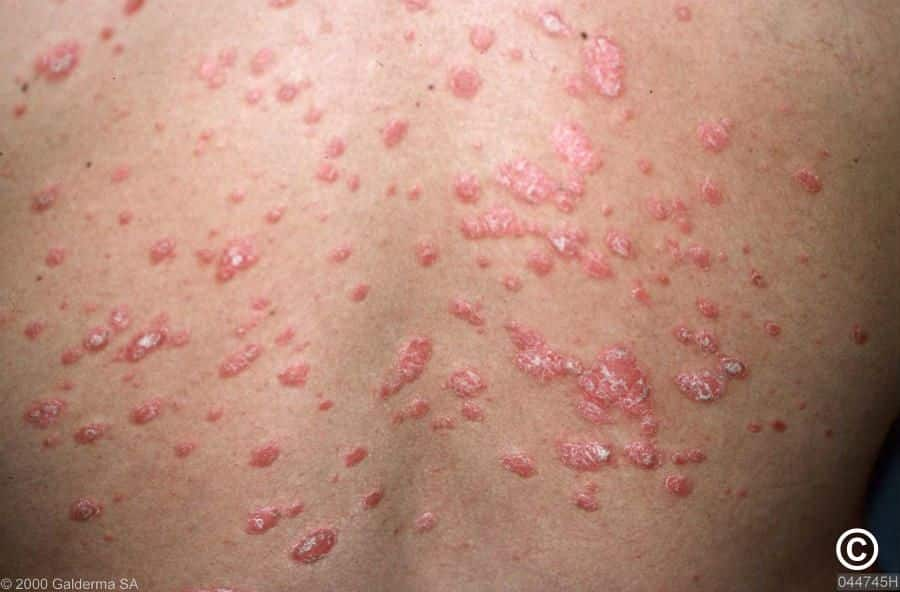 Guttate Psoriasis