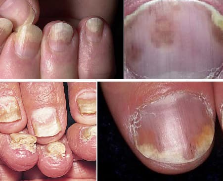 Nail Psoriasis