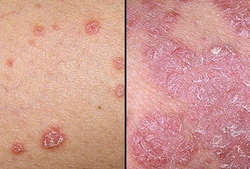 Psoriasis