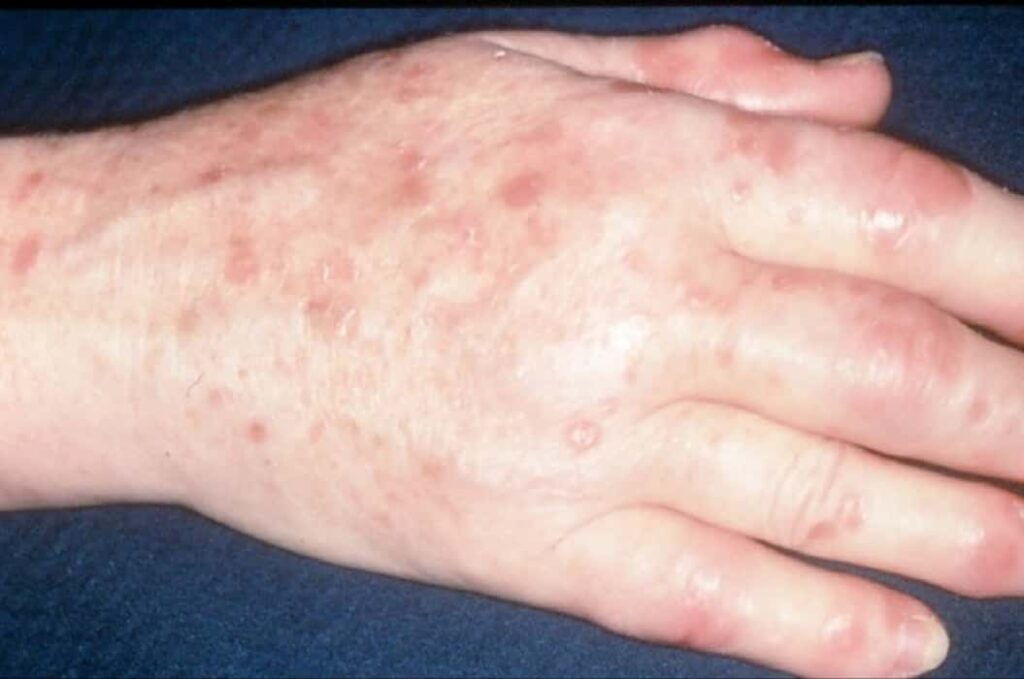 Psoriatic Arthritis