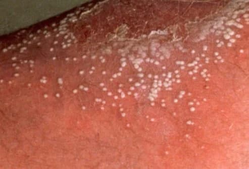 Pustular Psoriasis