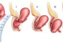 Uterine Prolapse