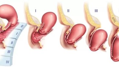 Uterine Prolapse