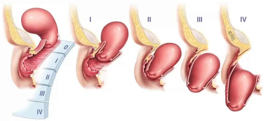 Uterine Prolapse