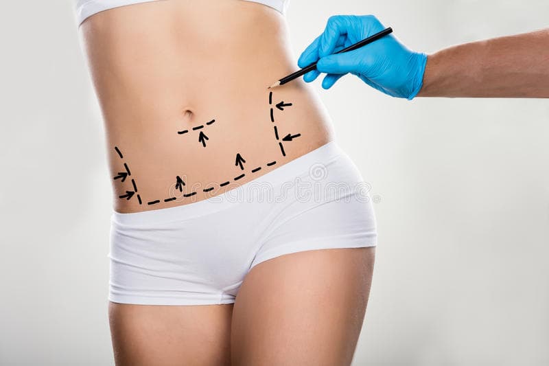 Abdominoplasty