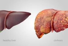 Early Signs Of Liver Disease