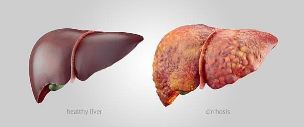 Early Signs Of Liver Disease