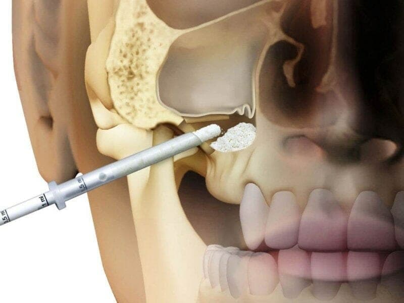 What Is A Sinus Lift