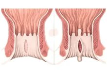 Hernia Vs Hemorrhoid