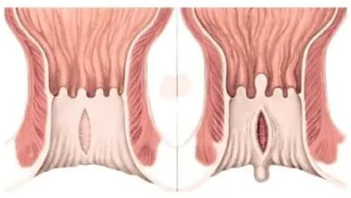 Hernia Vs Hemorrhoid