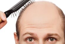 Tips on Treating Male Pattern Hair Loss