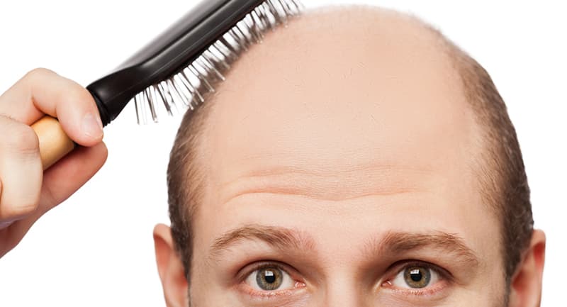 Tips on Treating Male Pattern Hair Loss