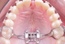 Rapid-Palatal-Expander