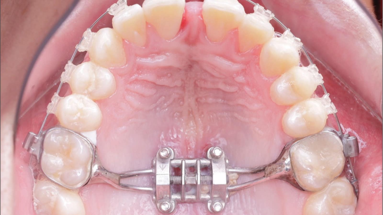 Rapid Palatal Expander: Who Is This Procedure Suitable For? Rapid Palatal Expander: Who Is This Procedure Suitable For?