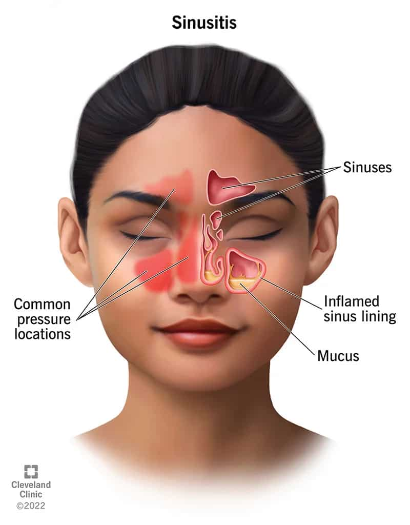 Are Sinus Infections Contagious