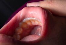 How long until a tooth infection kills you?